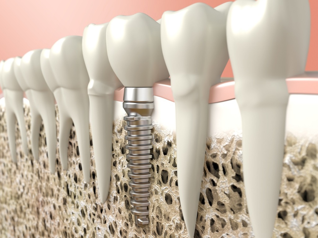Alternativas de tratamiento para ausencia de hueso en implantes dentales